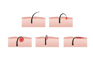 ingrown hairs