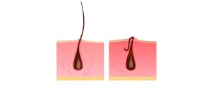 ingrown hair