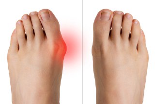 انحراف شست پا (Hallux valgus) چیست و چگونه درمان می شود؟