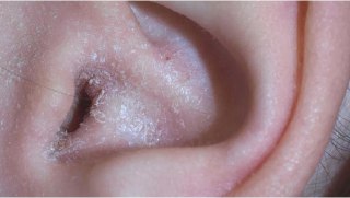 چرا گوش پوسته پوسته می شود؟